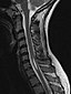 Syringomyelia.jpg