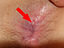 Anal fissure 2.jpg