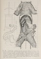 Catheterisme simultane des gros vaisseaux arteriels et veineux (veines caves et aorte), par la veine et l'artere crurale droite, au moyen de sondes renfermant de longes aiguilles thermo-electriques.png