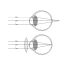 Hypermetropia.svg
